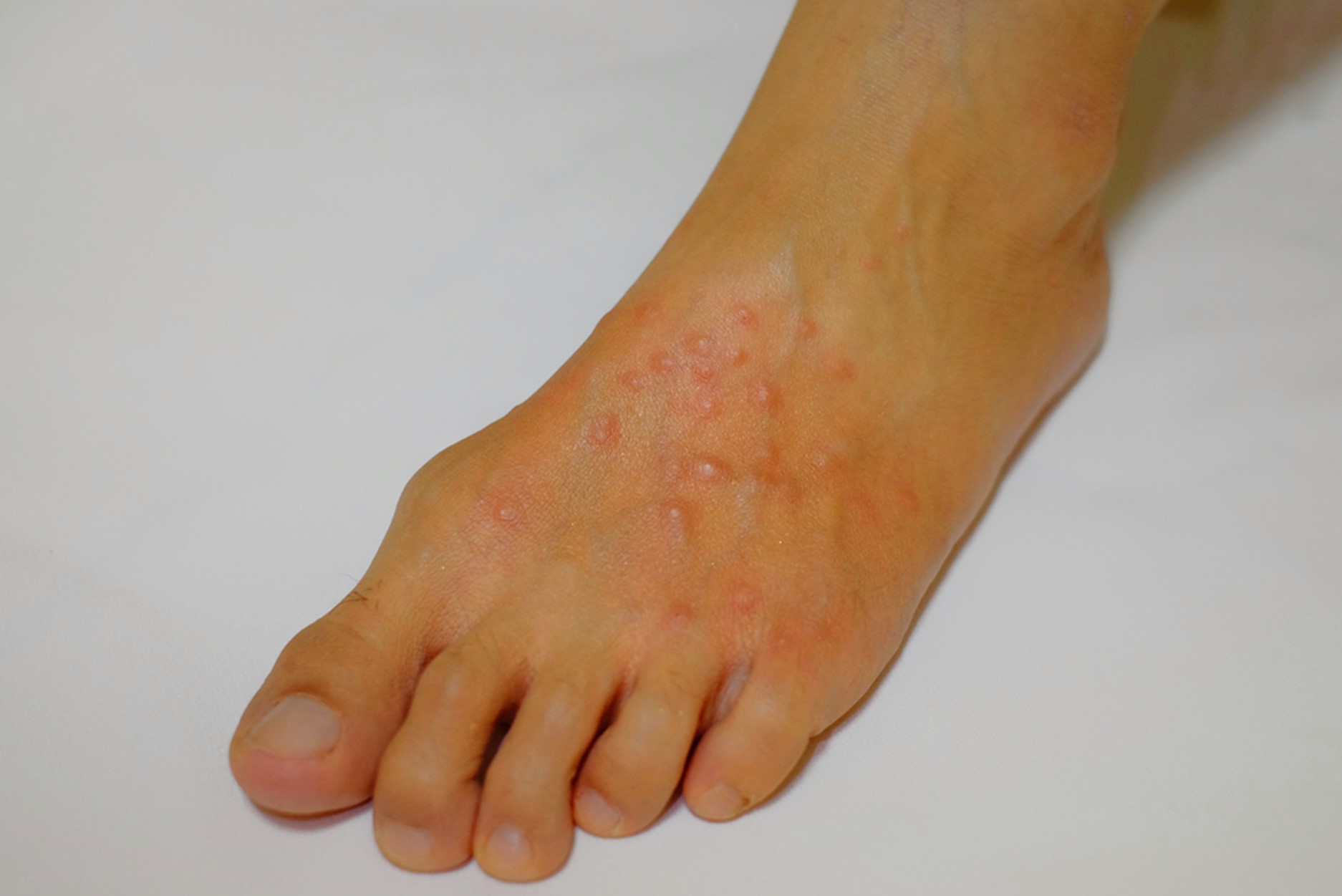 A foot with red imported fire ant stings.