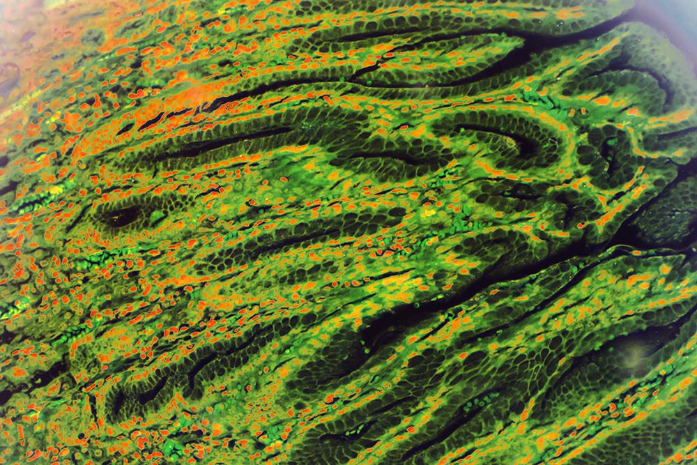 Image of gastric mucosa intestinal metaplasia under microscopy